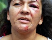 Roneide Alves foi mais uma vítima de atropelamento na ladeira