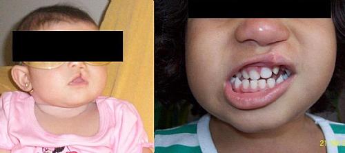 Maria Luísa antes e depois da cirurgia de correção do Lábio Leporino