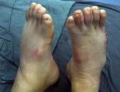 Imagem dos pés do menino após cirurgia