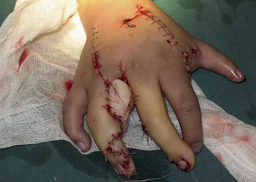 Menino foi submetido a cirurgia em Shenyang para retirada dos dedos a mais. A imagem mostra a mão direita do garoto de 6 anos de idade. O menino que nasceu com 15 dedos nas mãos e 16 nos pés