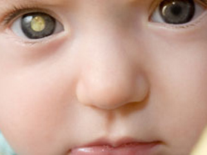 Montagem mostra como fotos podem revelar se a criança é portadora de retinoblastoma