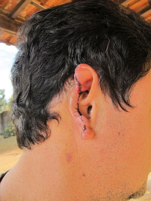 Cirurgia para reconstrução da orelha pode custar R$ 35 mil