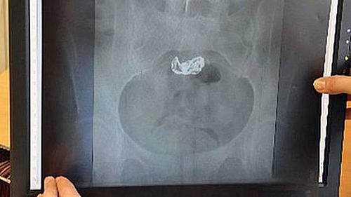 No exame de raio-x, a pulseira foi encontrada no estômago da mulher