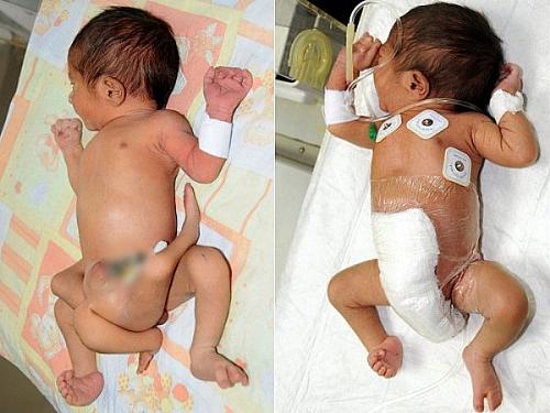 O bebê paquistanês, antes e depois da cirurgia