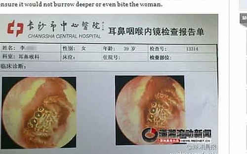 Aranha retirada de paciente na China