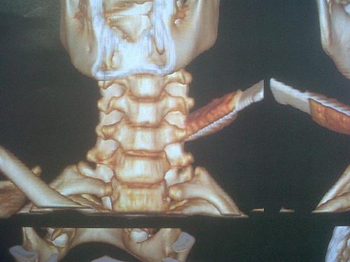 Tomografia mostra parte de faca alojada no pescoço do jovem