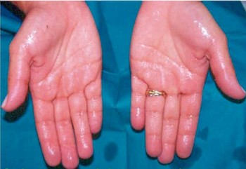 Suor nas mãos, pés e axilias é um dos sinais mais visíveis da doença