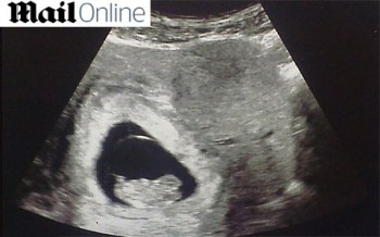 Ultrassom mostra "fantasma" ao lado de bebê