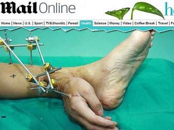 Médicos implantam mão de paciente na perna