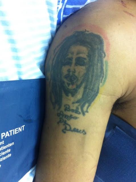 Paciente tem tatuagem do Bob Marley no braço