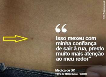 Médica foi agredida com agulhada quando andava perto da Av. Paulista, em São Paulo; seta amarela indica o ponto onde ela sofreu a agressão, nas costas