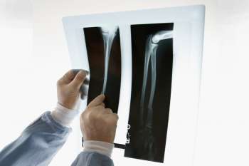 Radiografia apontou que criança estava com um bisturi dentro do braço esquerdo.Radiografia apontou que criança estava com um bisturi dentro do braço esquerdo.
