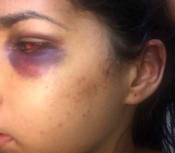 'Não consigo me olhar no espelho', relata Clara, que foi agredida com socos, chutes e mordidas pelo ex-companheiro (Foto: 